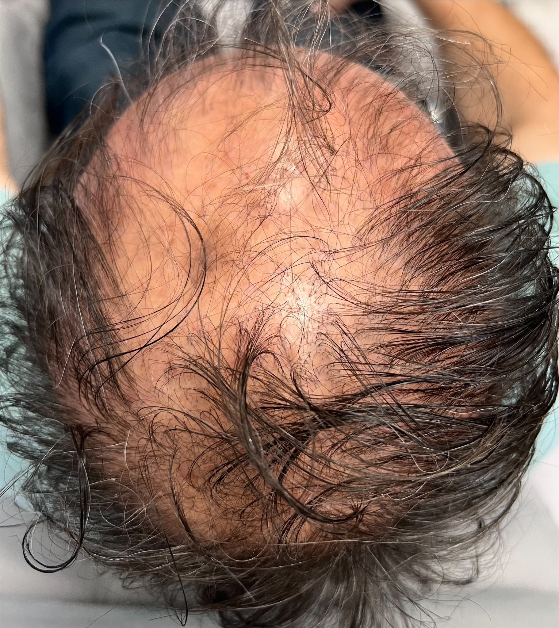 Revolutionary non-invasive Alma TED ultrasound technology for painless, effective hair regeneration. No needles needed.